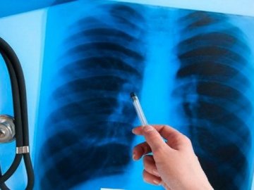У Луцьку безкоштовно обстежуватимуть легені