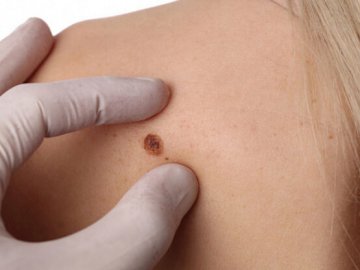 У селі Забороль безкоштовно обстежуватимуть на рак шкіри