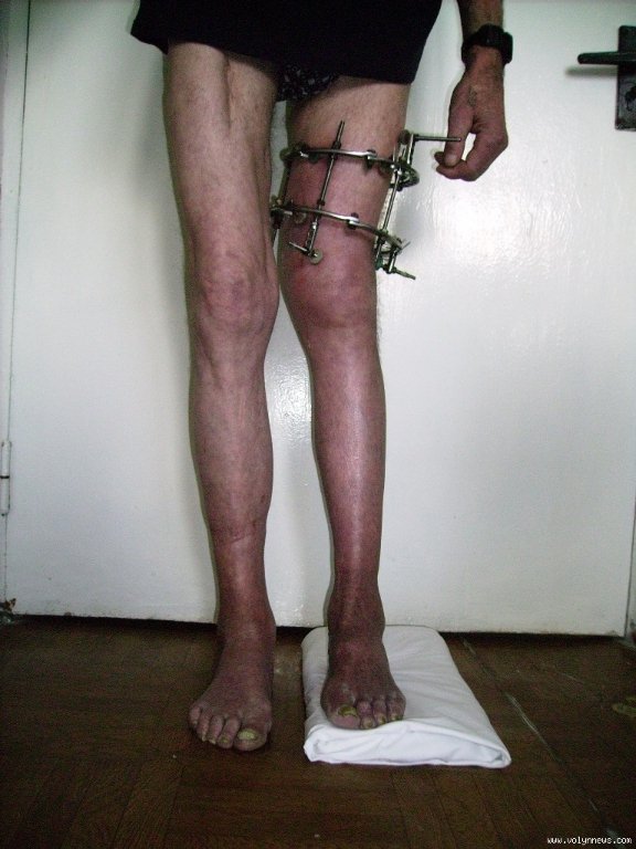 Компресійно-дистракційний апарат