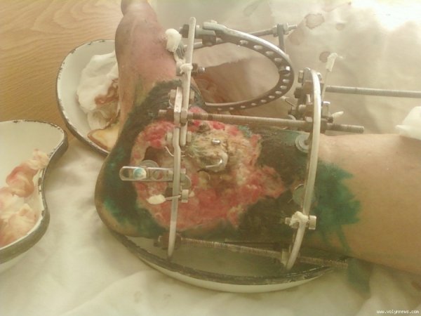 Пристрій для усунення деформації кісток нижніх кінцівок