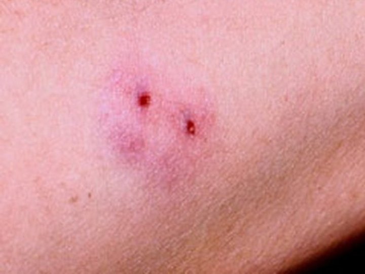 На Волині після укусу змії госпіталізували чоловіка