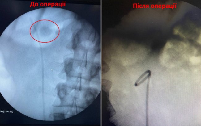 На Волині лікарі врятували нирку молодого чоловіка, де був чималий камінь 