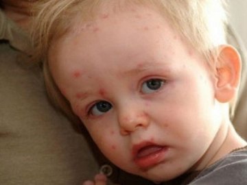 Кір «розбушувався»: за добу захворіли 15 волинян