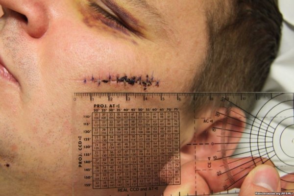 Відрізане вухо, проколи на руках, ‒ катування Булатова. ФОТО