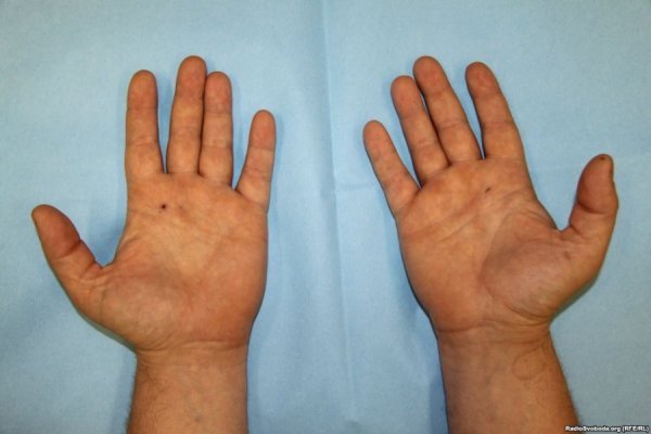 Відрізане вухо, проколи на руках, ‒ катування Булатова. ФОТО