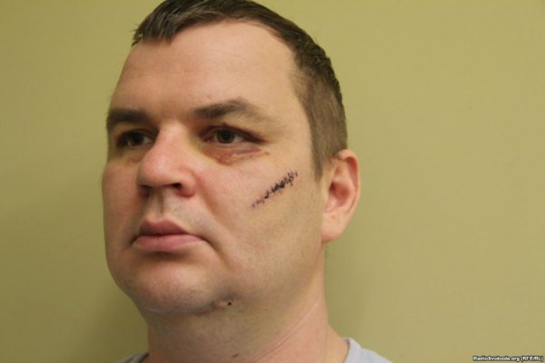 Відрізане вухо, проколи на руках, ‒ катування Булатова. ФОТО