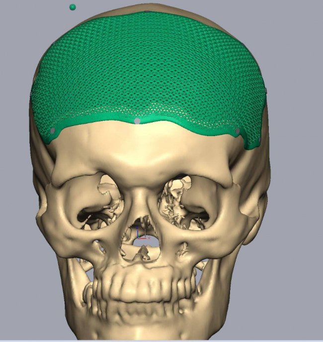 «Куля влучила в голову захисника і пройшла крізь мозок»: історія дитячого футбольного тренера з Волині 