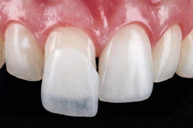 Особливості встановлення вінірів*