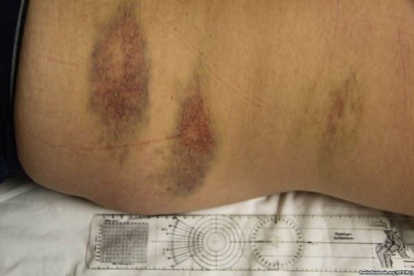 Відрізане вухо, проколи на руках, ‒ катування Булатова. ФОТО