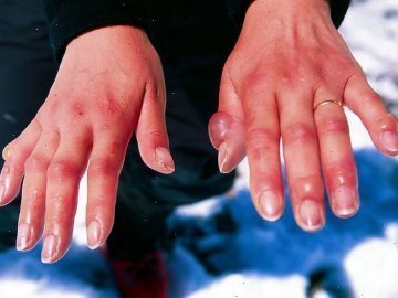 На Волині за різдвяні свята 16 людей постраждали через обмороження