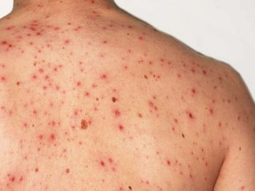 Супрун зруйнувала міф про вакцинацію проти кору для дорослих