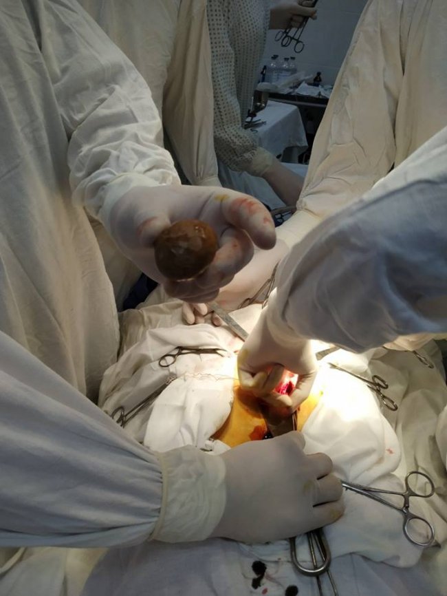 Волинські медики провели надскладну операцію з видалення величезних каменів з сечового міхура. ФОТО