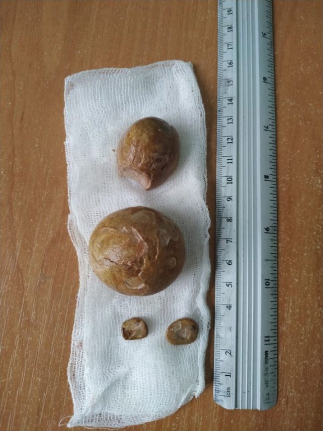 Волинські медики провели надскладну операцію з видалення величезних каменів з сечового міхура. ФОТО