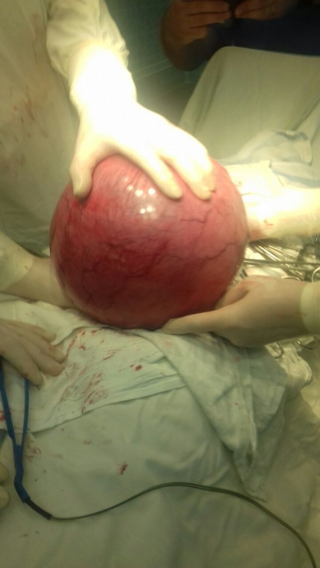 У Луцьку прооперували двох жінок з величезними пухлинами. ФОТО 18+