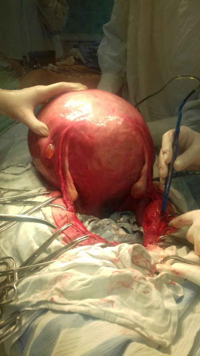 У Луцьку прооперували двох жінок з величезними пухлинами. ФОТО 18+