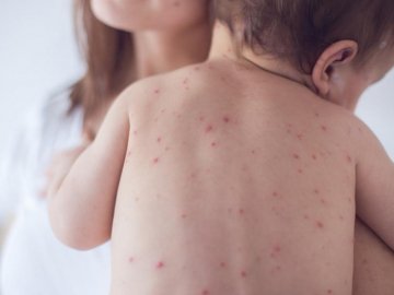 У Вінниці від кору померло 8-місячне немовля