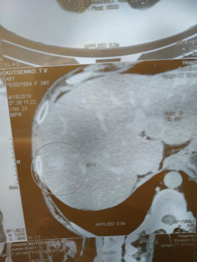 «Я мрію про день, коли метастаз не буде», – онкохвора волинянка