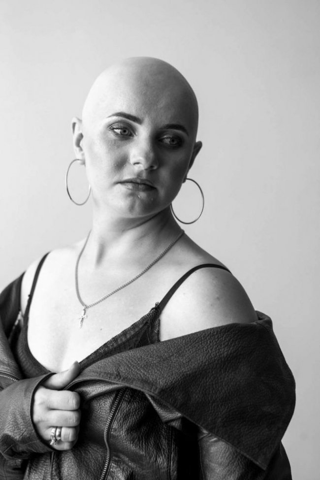 «Я втомилася ховати свою хворобу та змогла полюбити себе»: історія дівчини з Волині, яка з дитинства має важку недугу  