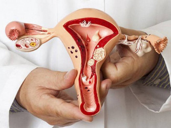 Ендометріоз як одна з причин безпліддя: особливості хвороби, причини розвитку, лікування*