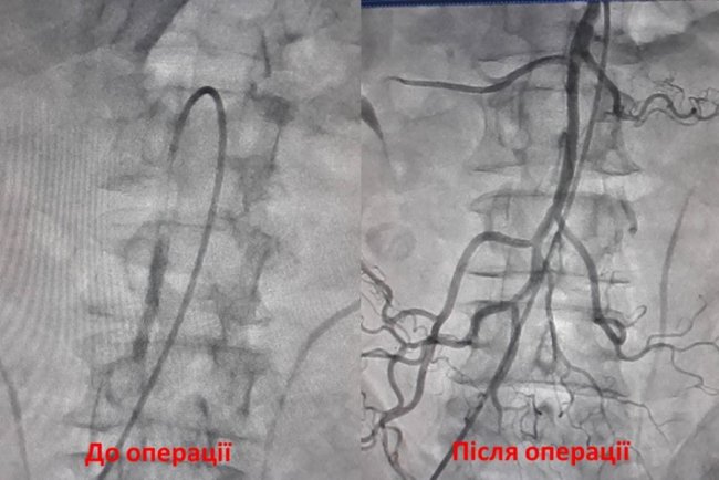 Волинські лікарі провели надскладну операцію з видалення тромбу. ФОТО