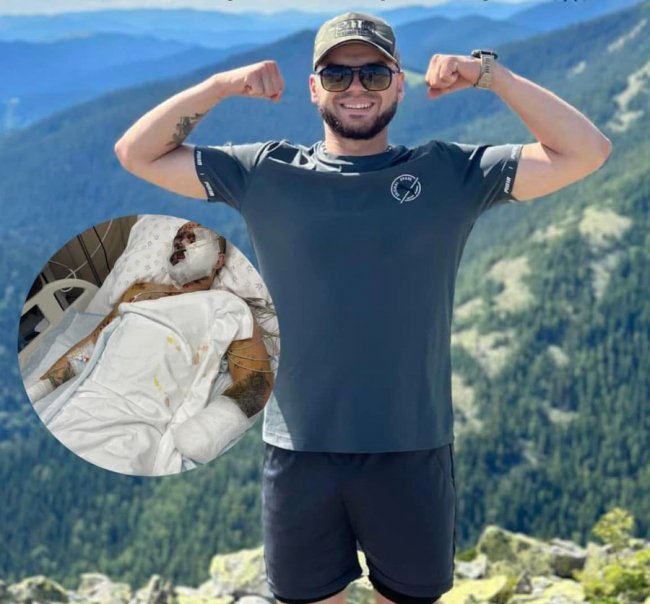 Протезування руки та ока: волинському герою потрібна допомога на лікування