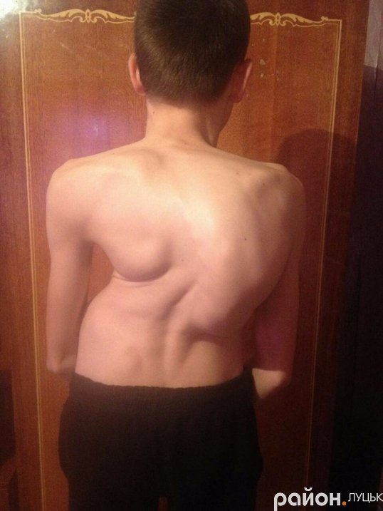 18-річному лучанину потрібно 300 тисяч на лікування