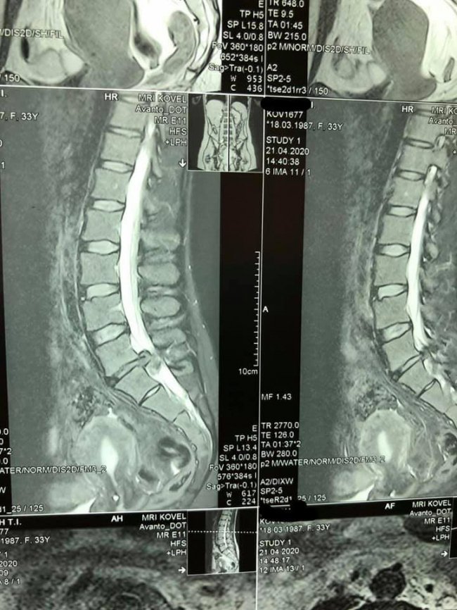 Зберегли можливість ходити: волинські лікарі повернули жінку до повноцінного життя. ФОТО