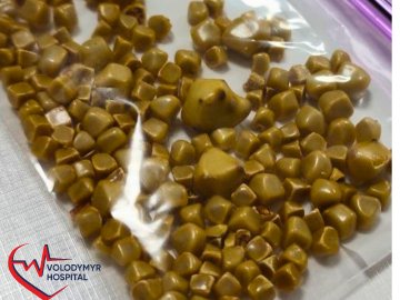 На Волині жінці видалили жовчний міхур із понад сотнею камінців