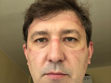 Рубці на обличчі: волинський лікар, показав наслідки боротьби з коронавірусом. ФОТО 