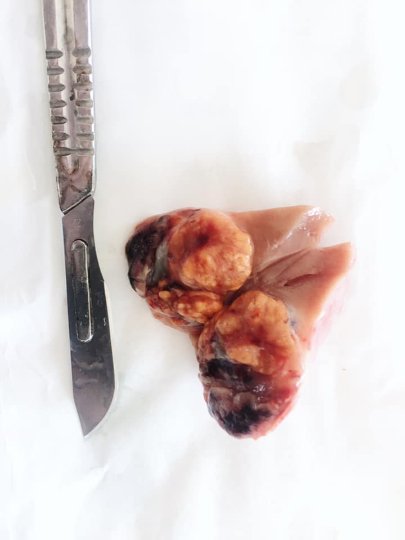 Волинські медики прооперували у пацієнта одразу два органи, уражених раком. ФОТО