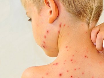 Де на Волині досі «гуляє» кір. ВІДЕО