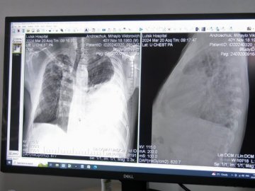 Кількість діагностованих випадків туберкульозу у дітей на Волині зросла у 5 разів