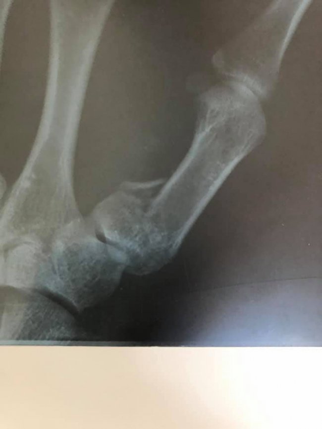 Волинські лікарі прооперували пацієнта, який впав з висоти зросту 