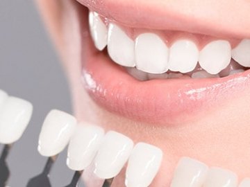 Коли варто ставити імпланти, а коли – вініри: відповідь луцького хірурга-стоматолога  