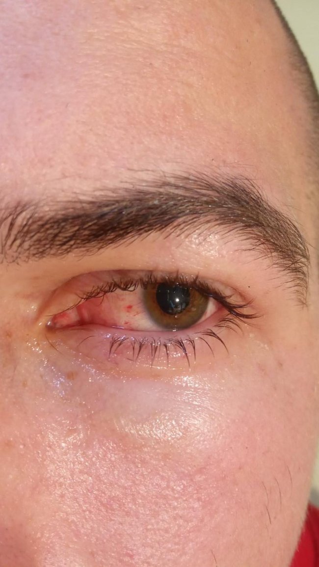 На Рівненщині з ока 17-річного юнака лікарі дістали рибальський гачок