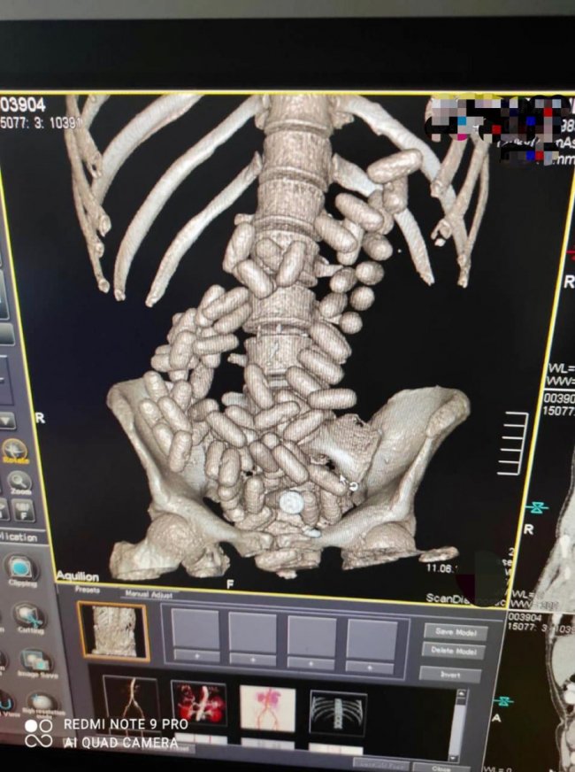 На Київщині спіймали наркокур'єра, який проковтнув понад кілограм кокаїну. ФОТО