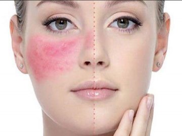 Лазерне шліфування обличчя – безпечний спосіб усунення косметологічних проблем*