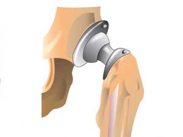 Відновлення після ендопротезування кульшового суглобу*