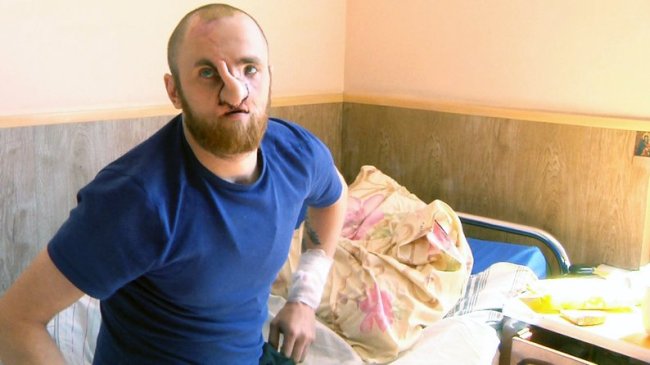Волинські лікарі з канадськими колегами відновлюють обличчя пораненому воїну. ВІДЕО