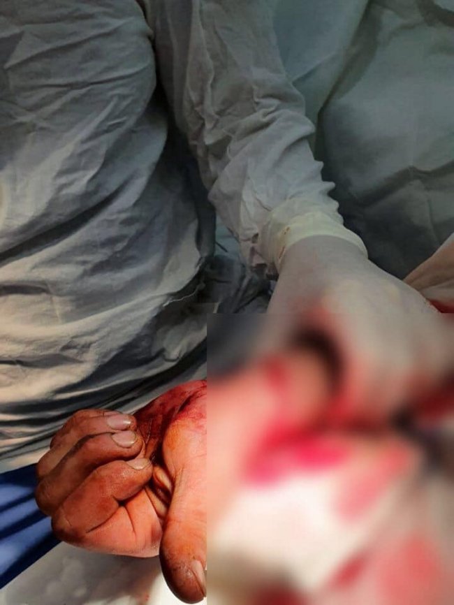 На Волині прооперували 27-річного хлопця, що травмувався болгаркою. ФОТО 18+ 