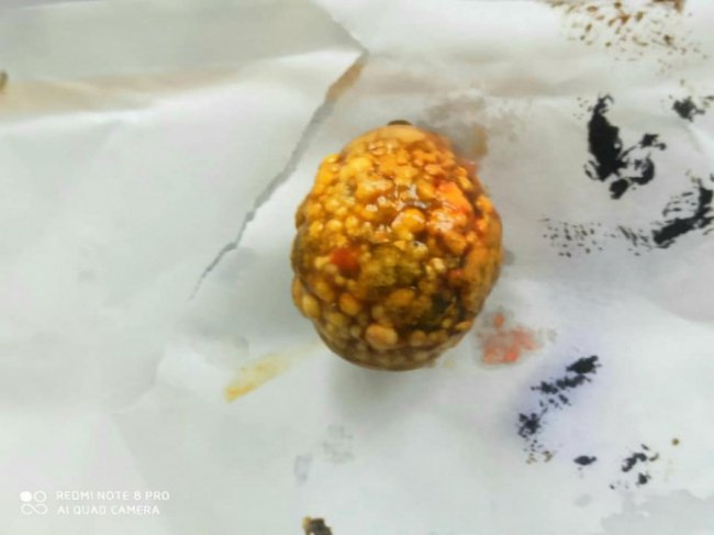 Волинські лікарі видалили жінці «мігруючий» камінь. ФОТО