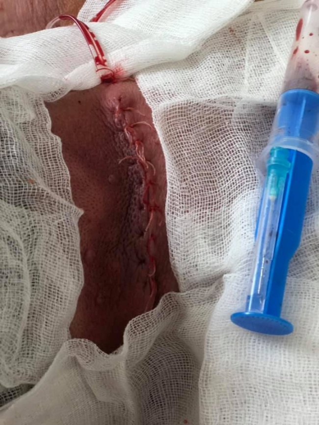 Ходив так три роки: на Волині чоловіку видалили чималу пухлину з шиї. ФОТО 18+ 