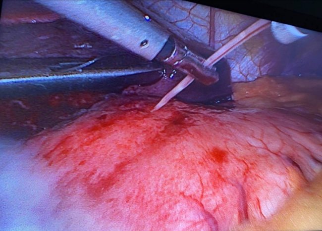 У Луцьку прооперували чоловіка, який ковтнув 5-сантиметрову риб’ячу кістку