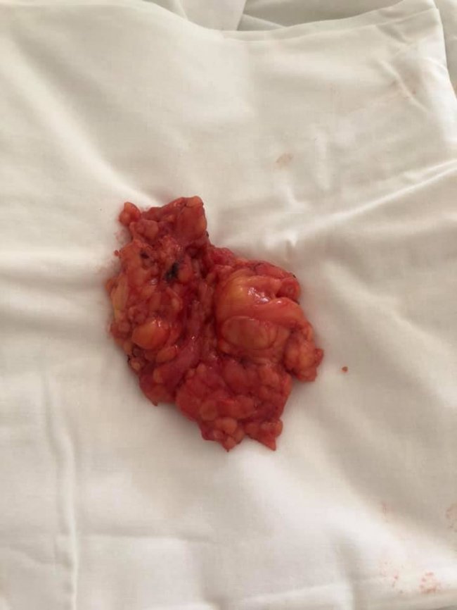 Ходив так три роки: на Волині чоловіку видалили чималу пухлину з шиї. ФОТО 18+ 