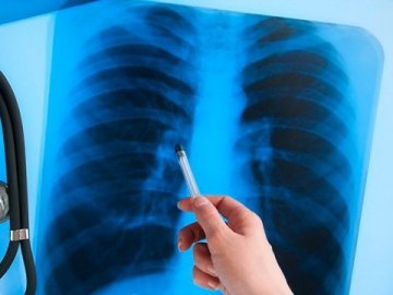 На Волині на туберкульоз захворіла дитина, якій менше року