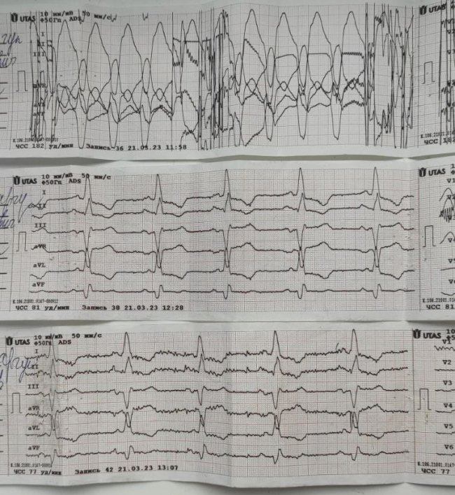 Медики «швидкої» відновили серцевий ритм 50-річному волинянину 