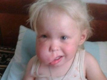 Хірург Валіхновський прооперує маленьку дівчинку, яку скалічив батько. ФОТО