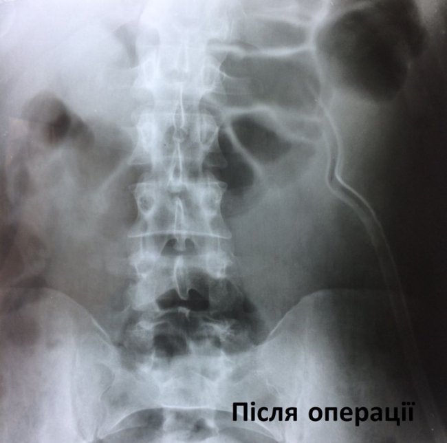 У волинській лікарні пацієнту видалили чималий камінь з нирки без розрізів
