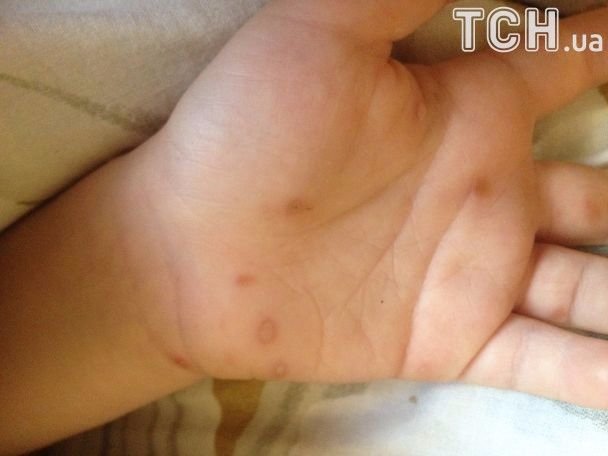 Дитсадки атакує вірус Коксакі, лікарі кажуть, що це – чутки