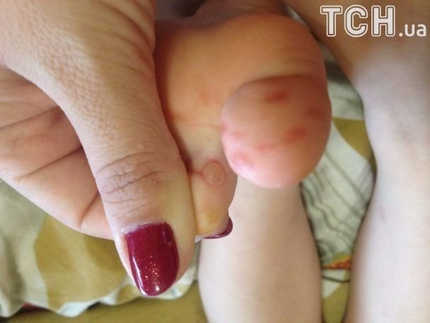 Дитсадки атакує вірус Коксакі, лікарі кажуть, що це – чутки